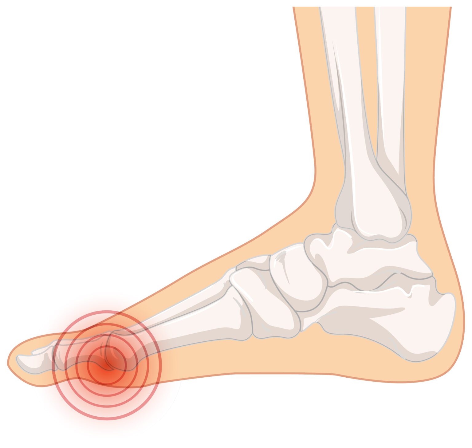 6 Things You Should Know About Metatarsophalangeal Joint Sprain ...